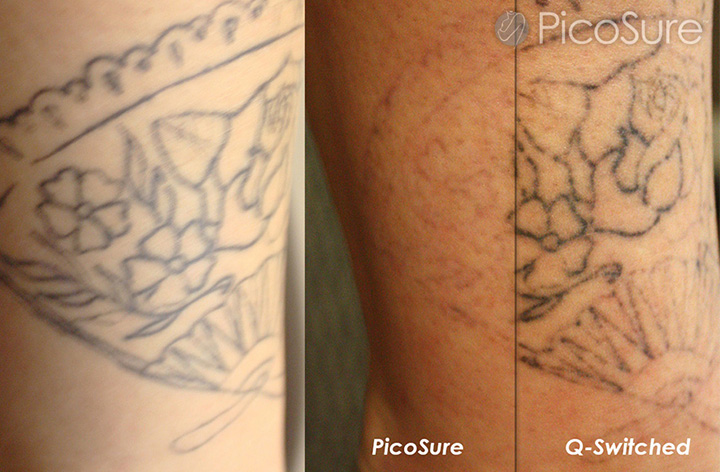 PicoSure™ takes advantage of PressureWave Technology to shatter the ...