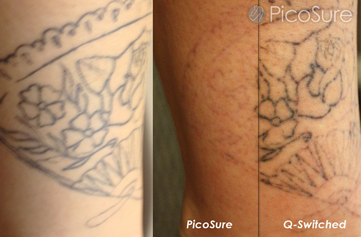 ... - Picosure Laser Tattoo Removal in Soho Central London - Reset Room