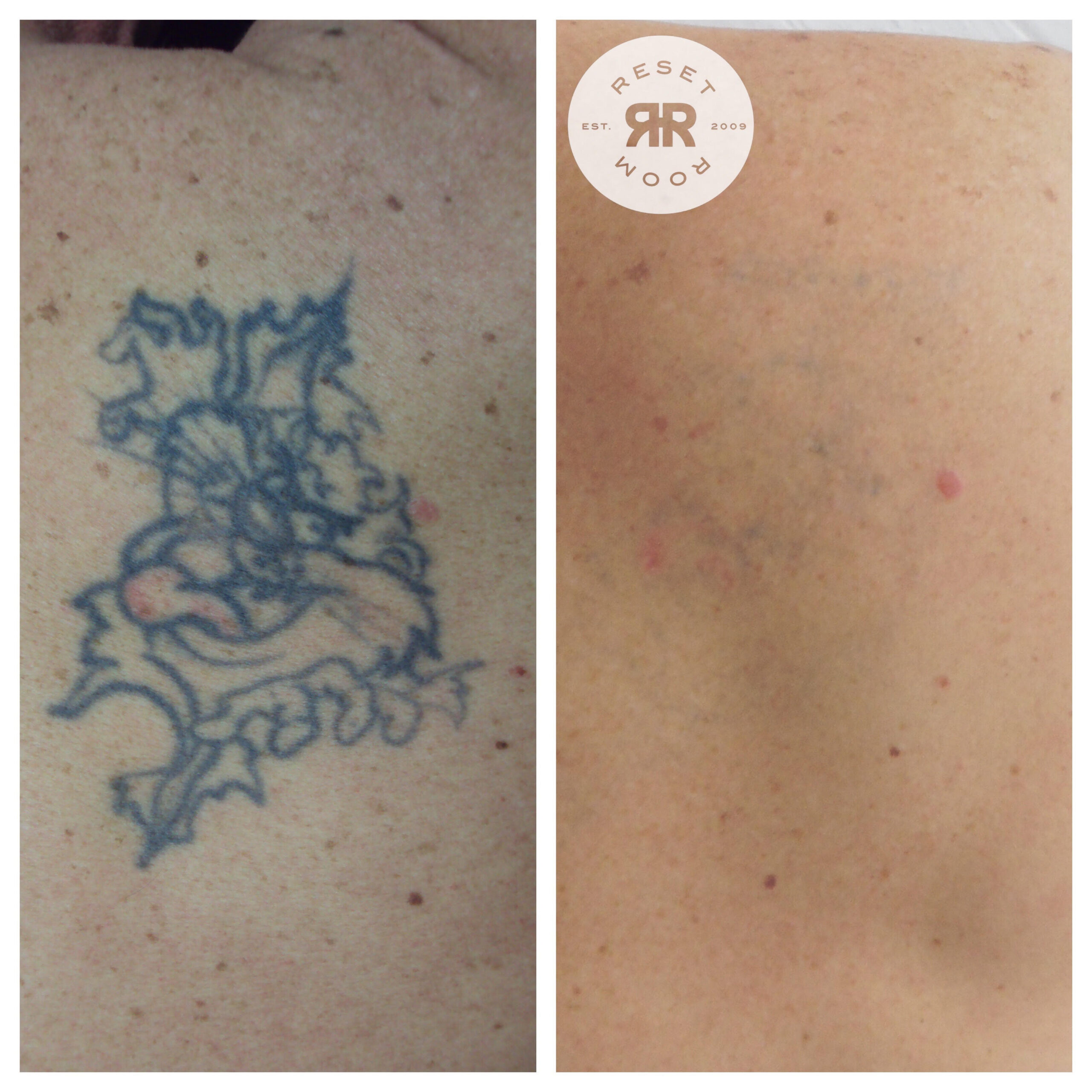 Tattoo Removal in Bristol - Advanced PicoSure™ Lasers Tattoo Removal in Bristol - Advanced PicoSure™ Lasers